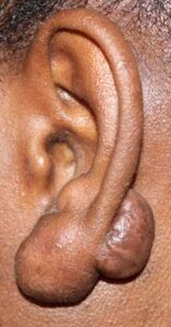 Keloids on ear