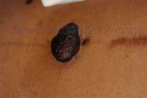 keloid scar