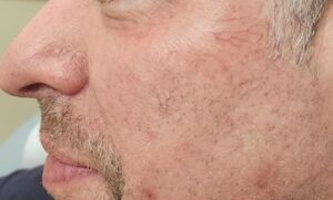 Rosacea treatment nyc as depicted by a man's cheek
