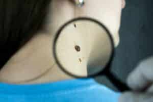 magnifiying glass over mole on woman's neck
