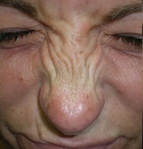 Botox for bunny lines as depicted by a wrinkled nose