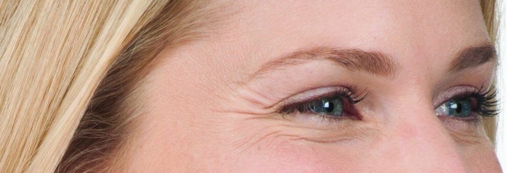 Botox for crows feet as depicted by crows feet while smiling