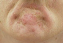 Chin Botox as depicted by a dimpled chin