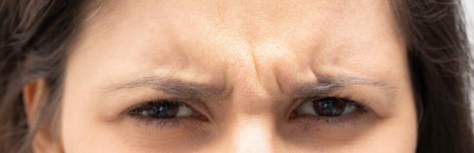 Botox for glabella as depicted by glabellar lines on a woman's face
