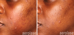 Aerolase Neo laser acne treatment dark skin tone
