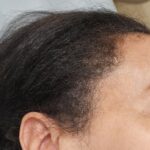 Menopause hair thinning treatment as depicted by woman's hair line