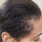 Menopause hair thinning treatment as depicted by woman's hair line