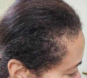 Before Image: Menopause hair thinning treatment