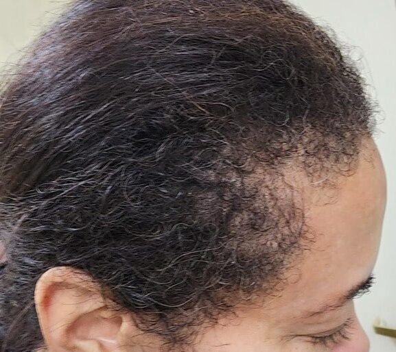 Before Image: Menopause hair thinning treatment - front