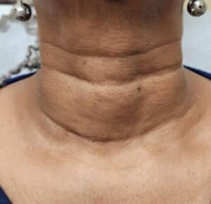 Before Image: Neck line treatment before and after