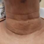 neck lines after 1
