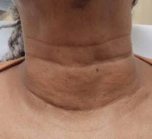 After Image: Neck line treatment before and after