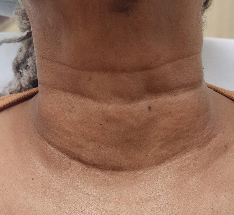 After Image: Neck line treatment before and after - front