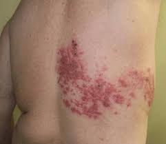 herpes Zoster