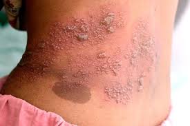 shingles doctor