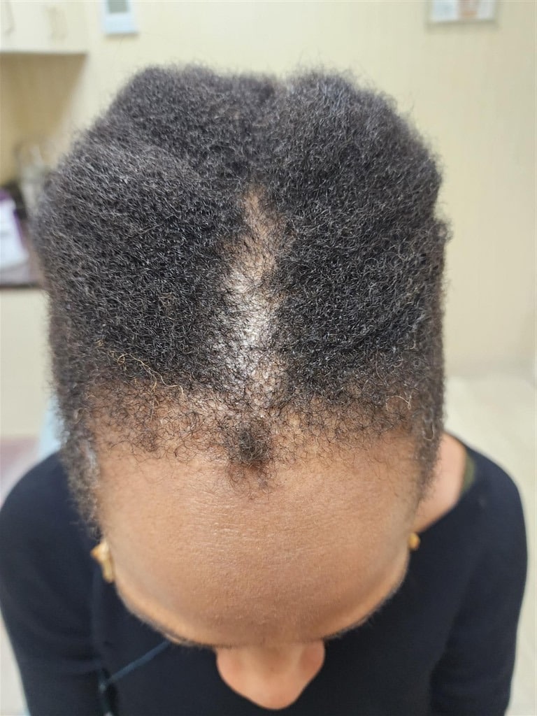 After Image: Traction alopecia reversible - front