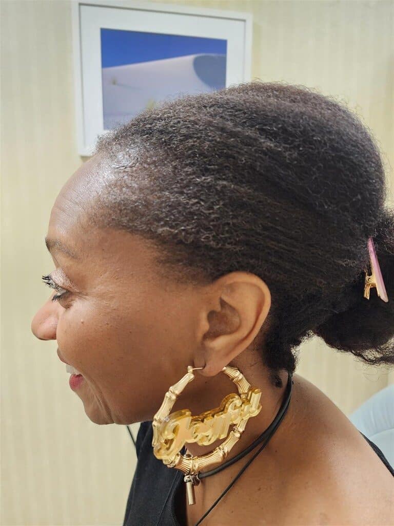 After Image: Traction alopecia reversible - front