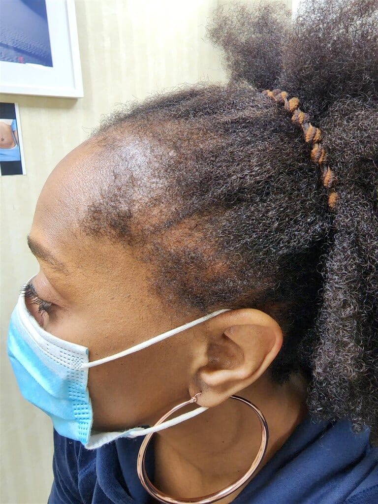 Before Image: Traction alopecia reversible - front