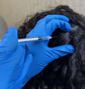 steroid injections for hair loss as depicted by gloved hands holding a syringe over a scalp