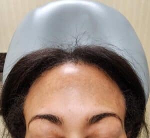 Sunscreen for Melasma as depicted by woman's forehead with dark patches