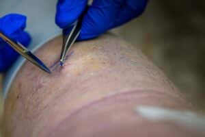 mole removal in New York as depicted by suturing skin on back