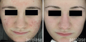 Before and after NeoClear acne treatment photos