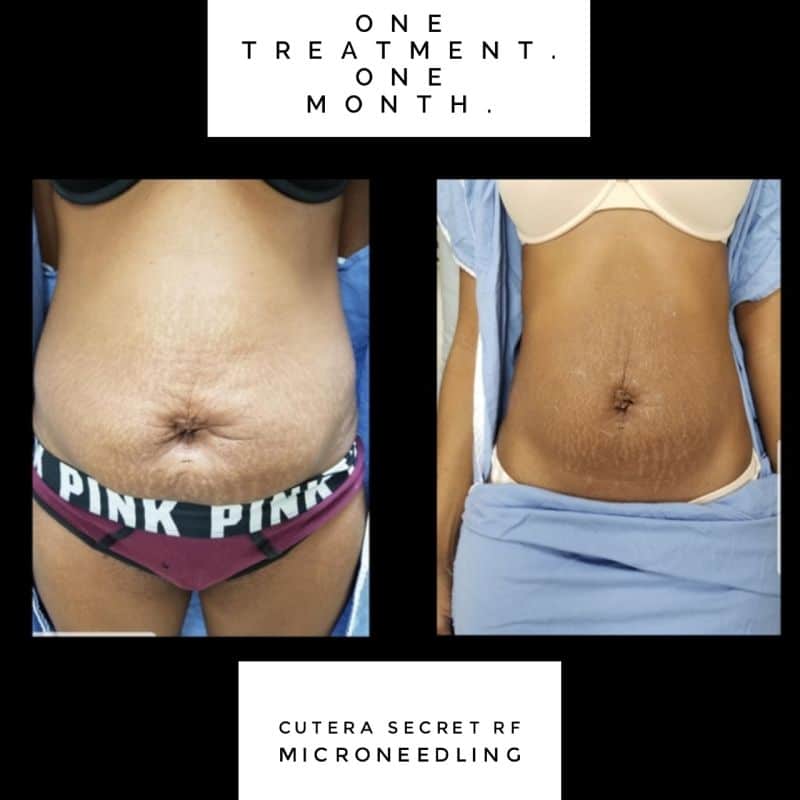 Cutera Secret RF abdomen before and after A before and after example of a woman receiving RF microneedling treatment for abdominal stretch marks at Aglow Dermatology.