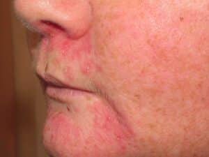 dermatologist for perioral dermatitis