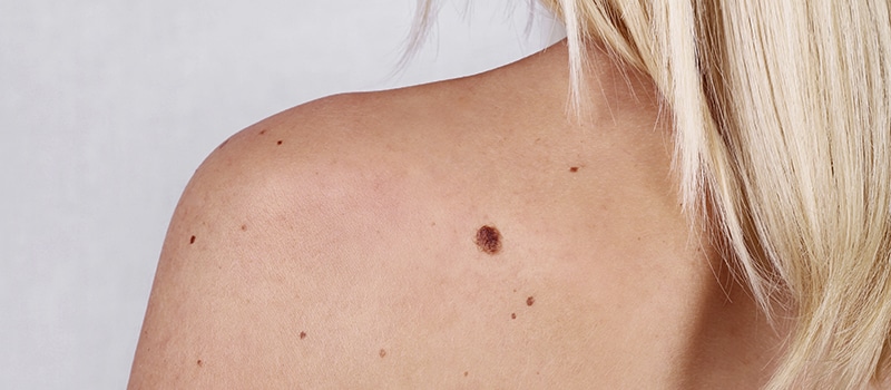 Mole on a woman's back, related to mole removal by Dr. Dina D. Strachan