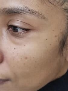 Dermatosis Papulosa Nigra on a person's face.