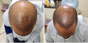 AlmaTED 2 treatments Alma TED before and after