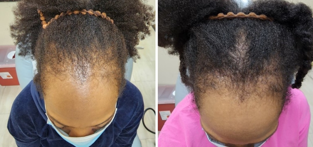 Screenshot 20230316 133620 Facebook A before and after image of hair loss treatment for skin of color at Aglow Dermatology.