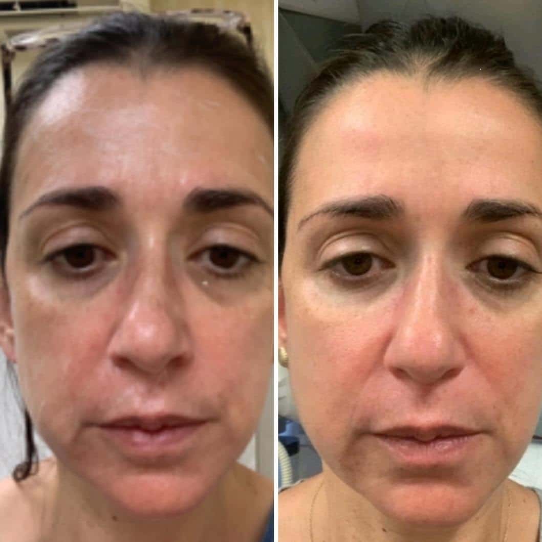 Cutera Secret RF 1 month lady's face after Cutera Secret RF 1 month - NYC microneedling Secret RF