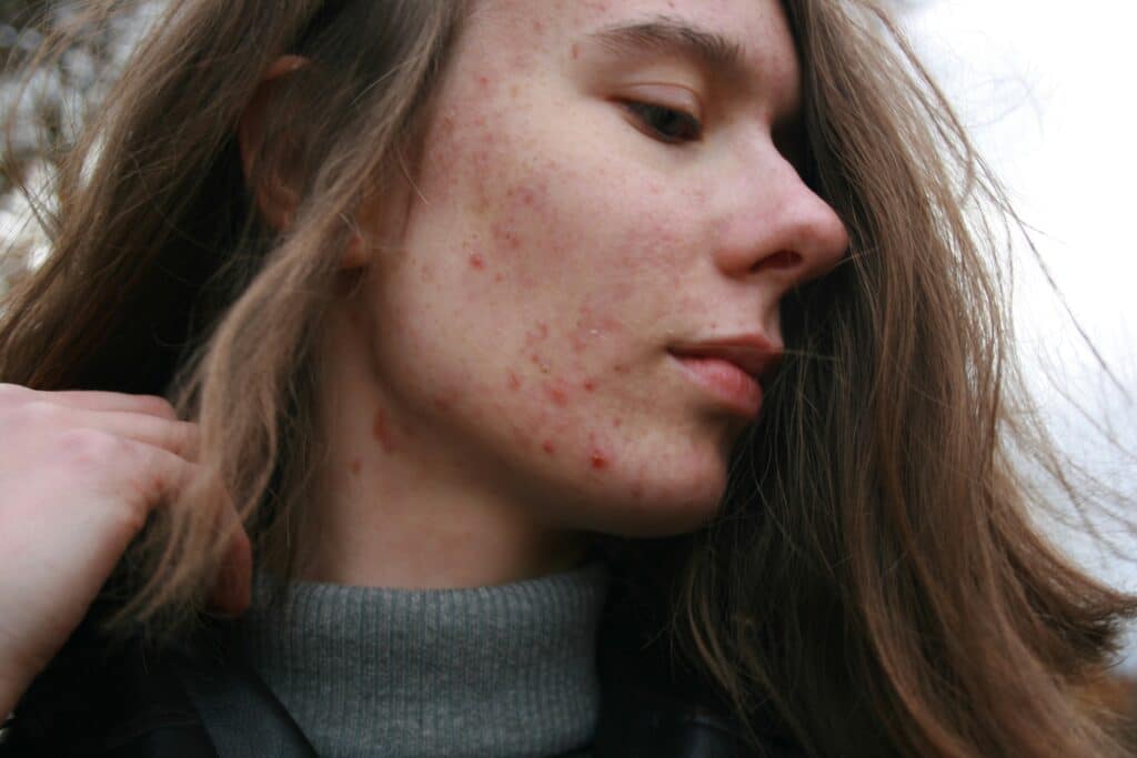 dermatologist for pimples as depicted by a woman with acne in profile