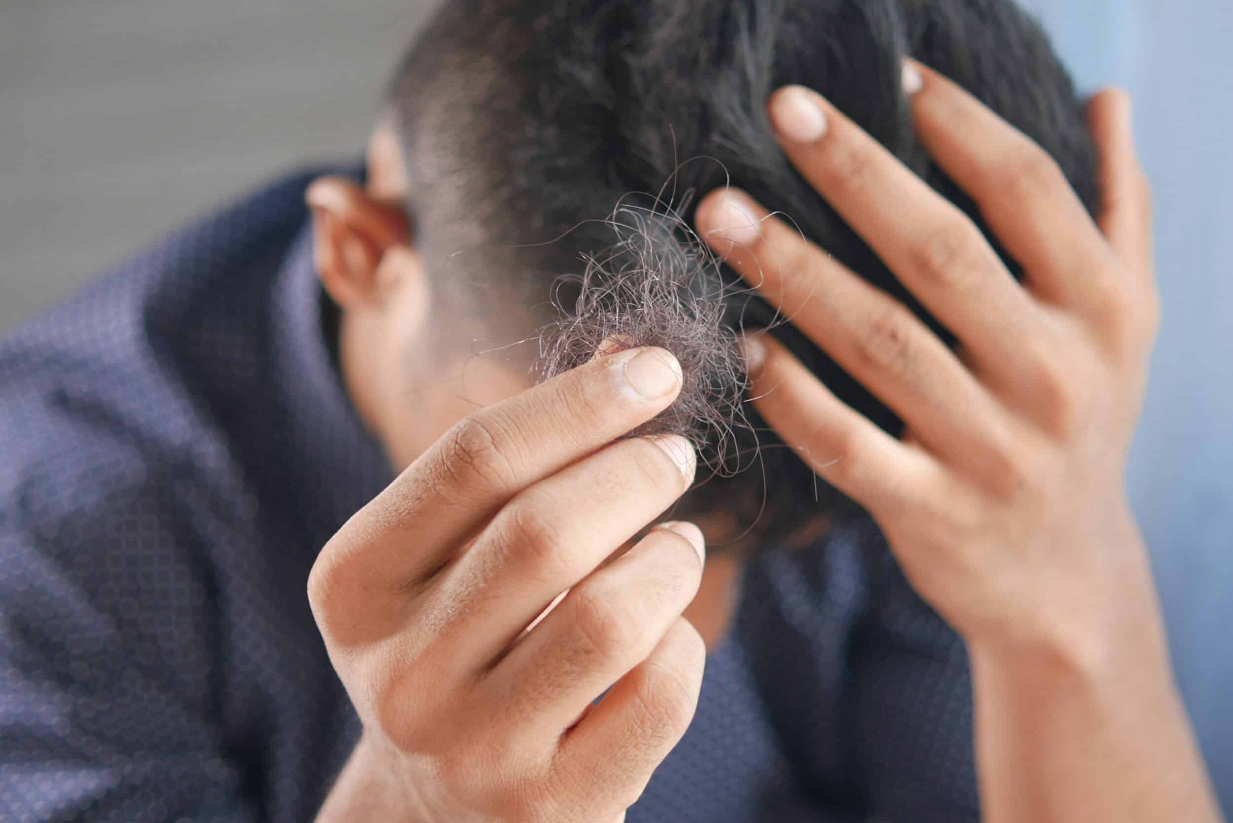 hair loss treatments for men