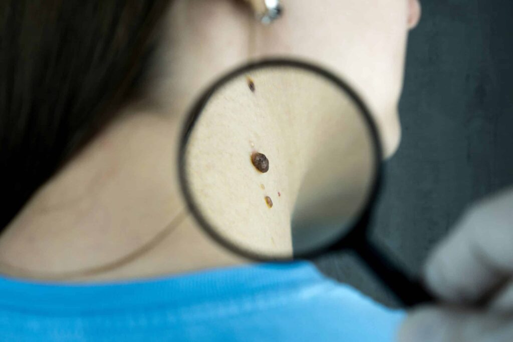 obesity and skin conditions moles on neck