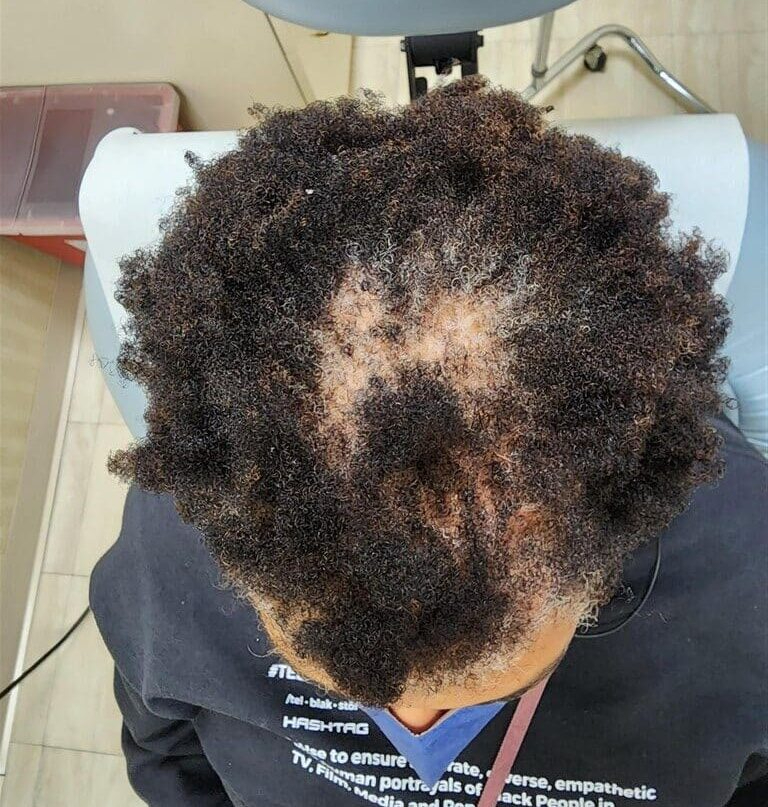 Before Image: Alma Ted Hair Treatment Before and After - front