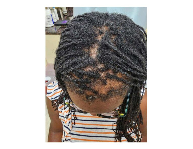 After Image: CCCA Before and After treatment - front