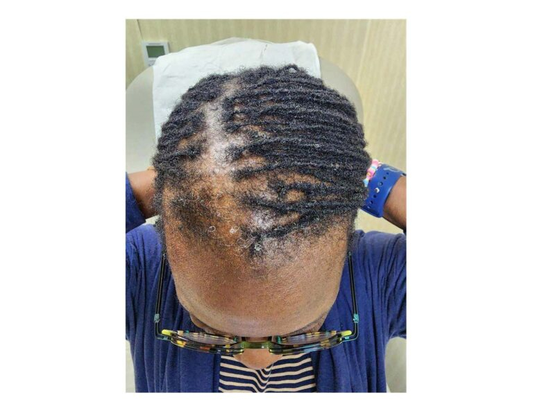 Before Image: CCCA Before and After treatment - front