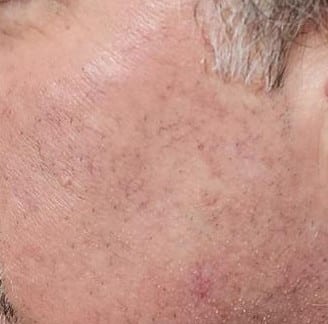 After Image: Laser treatment for rosacea before and after - left-side