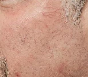 Before Image: Laser treatment for rosacea before and after - left-side