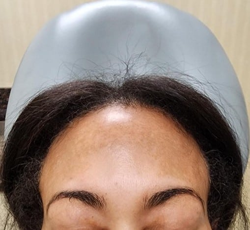 laser for melasma as depicted by a dark patch on a woman's forehead