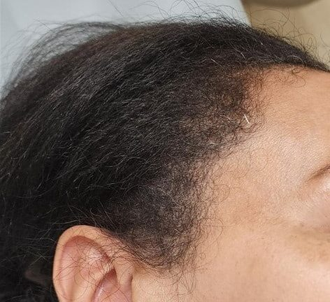 After Image: Menopause hair thinning treatment - right-side