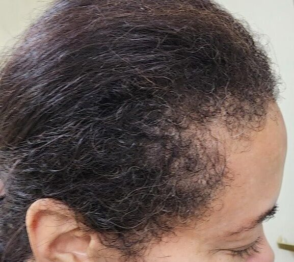 Before Image: Menopause hair thinning treatment - right-side