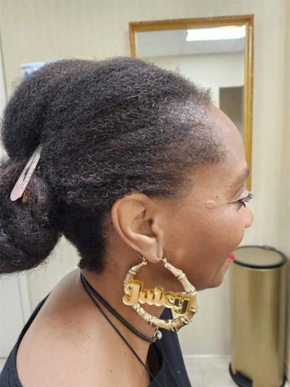 After Image: Traction alopecia reversible - right-side