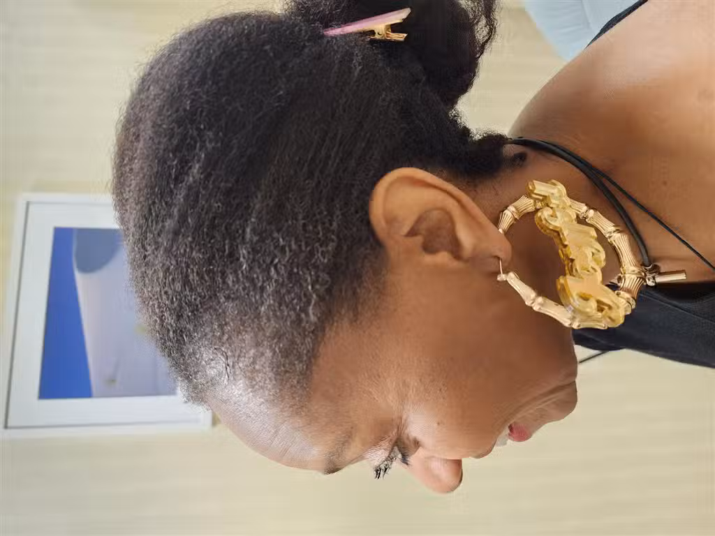 After Image: Traction alopecia reversible - left-side