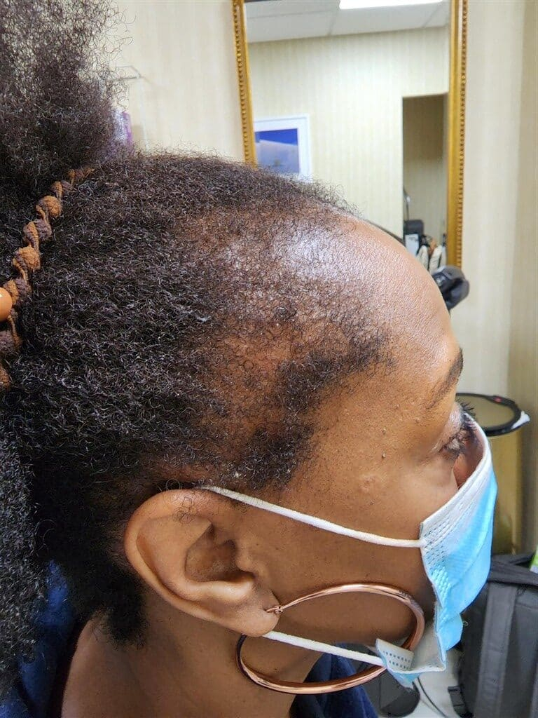 Before Image: Traction alopecia reversible - right-side