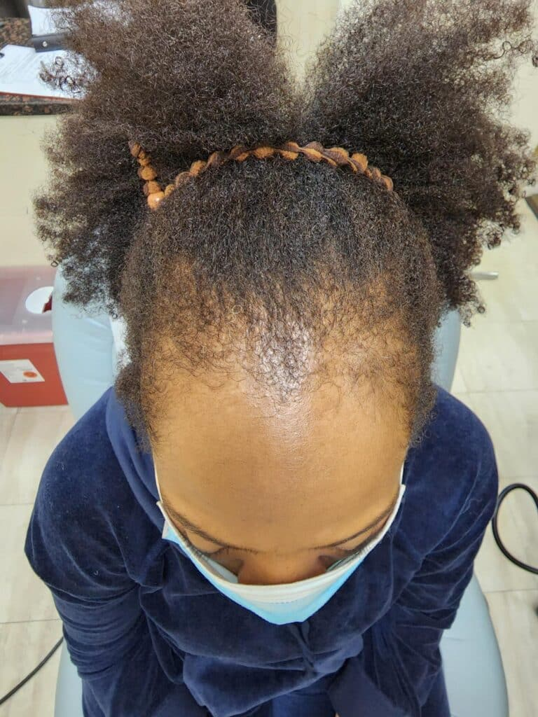 Before Image: Traction alopecia reversible - front