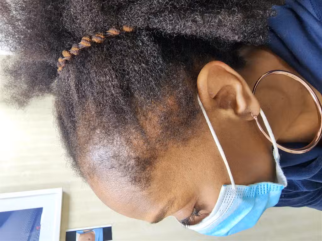 Before Image: Traction alopecia reversible - left-side