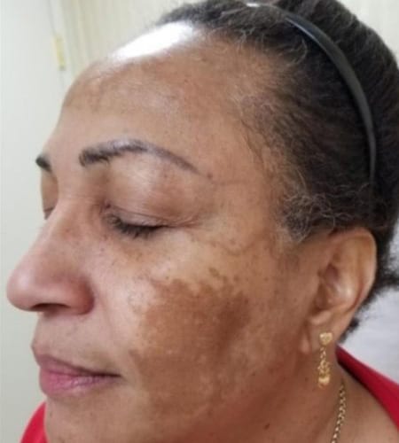 Chemical peels for melsma as depicted by a dark patch on a woman's cheek